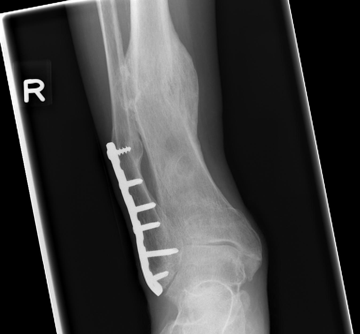 Distal Tibial Malunion